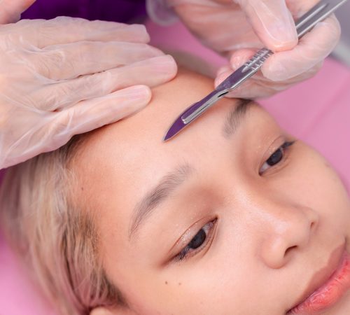 Close-up of a dermaplaning procedure exfoliating the skin and removing facial hair, performed at an aesthetic clinic.